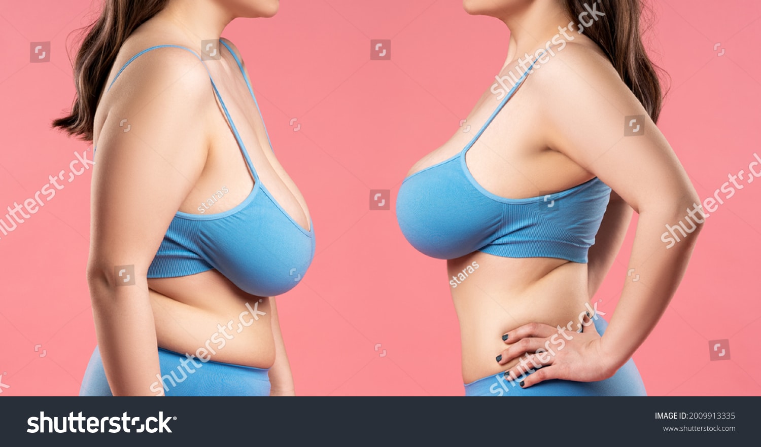 stock-photo-before-and-after-breast-augmentation-concept-woman-with-very-large-silicone-breasts-after-2009913335