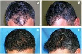 hair transplant,fue hair transplant